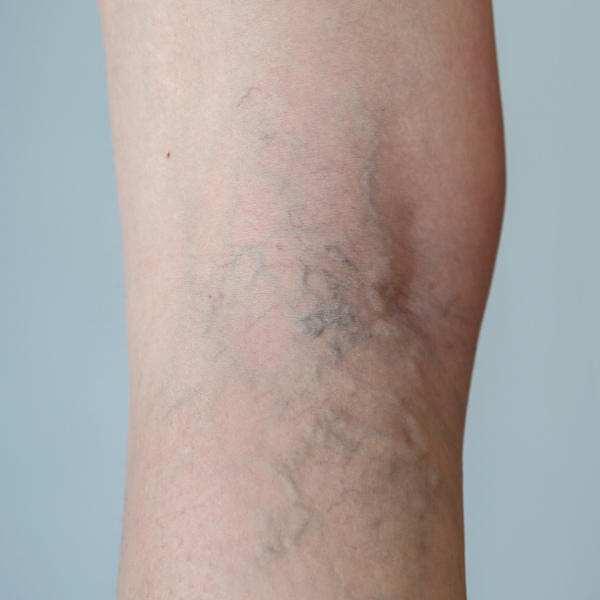 varices